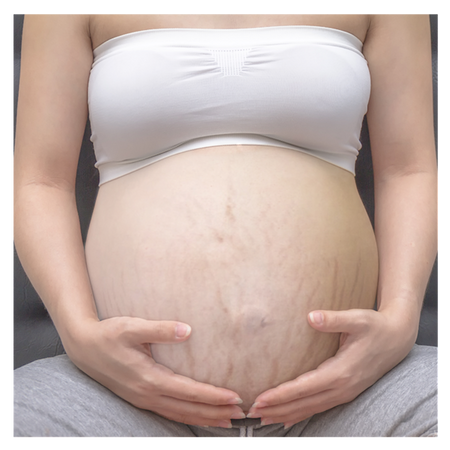 Ardo krem przeciw rozstępom Natal Anti-Strech